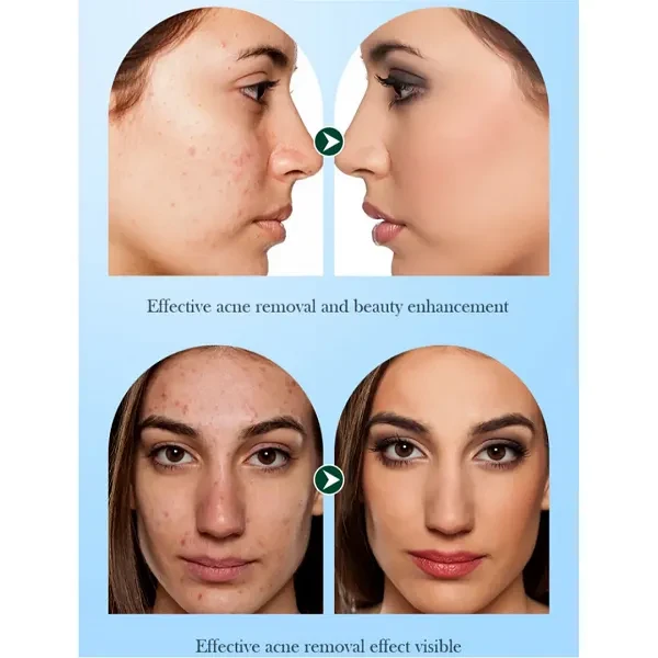 Sadoer Acnes Tea Tree Skin Care Deeping Clean Moisturizes Hydrating Oil Control