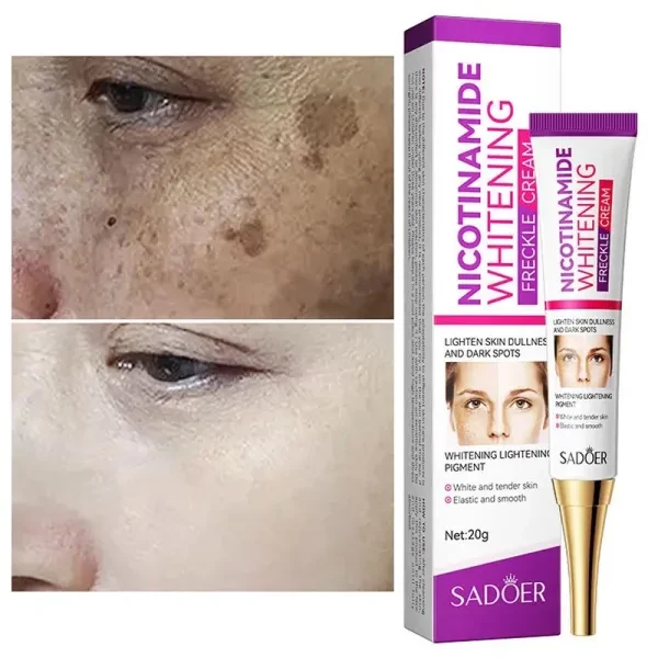 Freckle Removal Cream Whitening Lighten Dullness Dark Spot Remover Soft Skin Moi