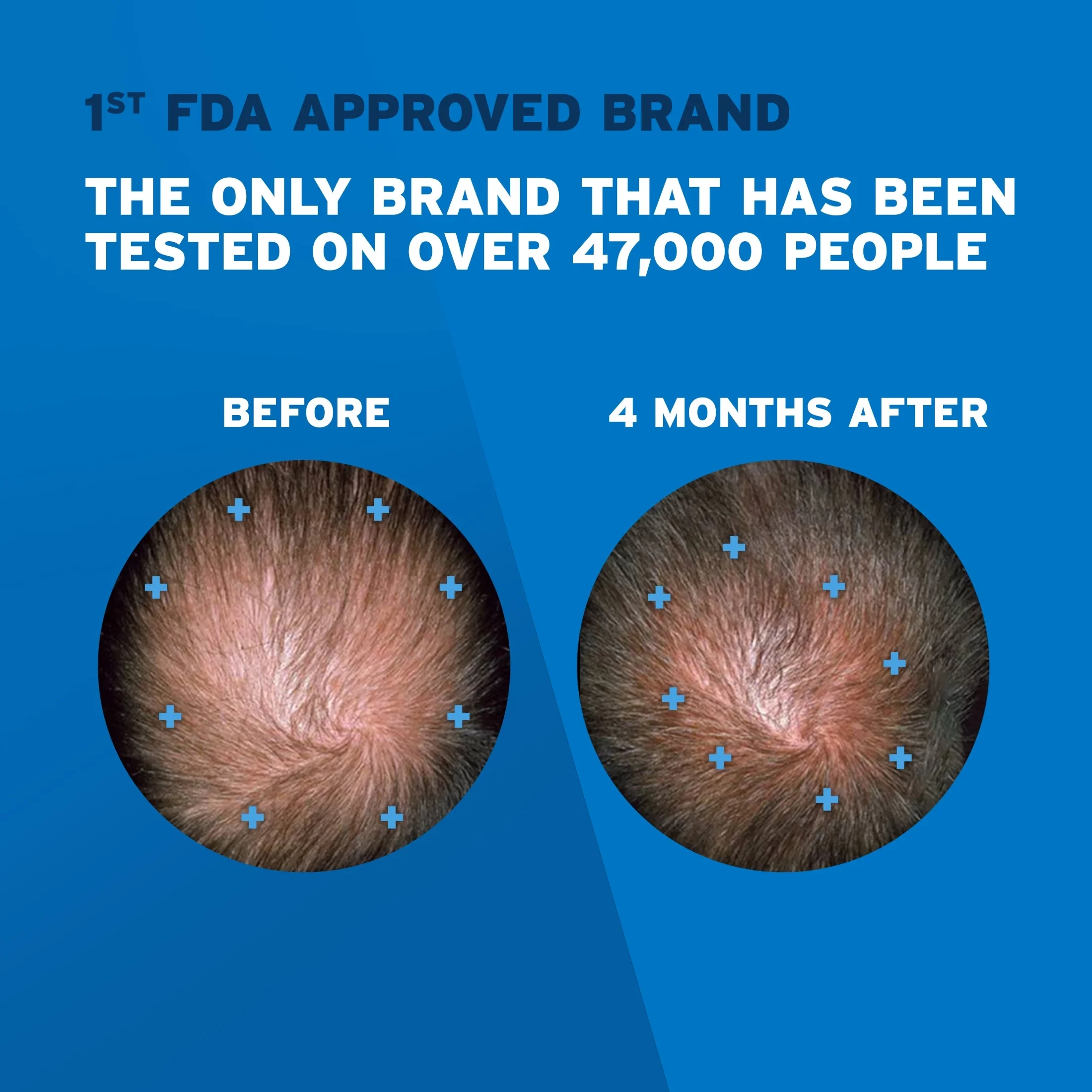 Men’s Rogaine Extra Strength 5% Minoxidil Topical Solution for Hair Loss and Hai